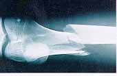 TORSIONAL BONE FRACTURE